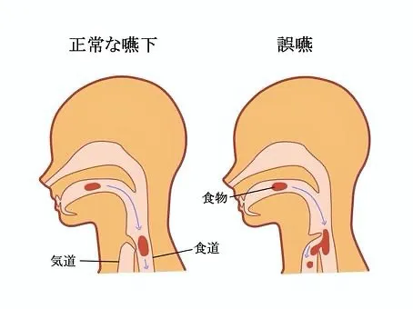 高齢者の嚥下障害防止を！